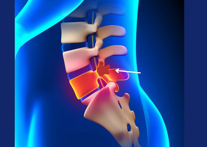 Lumbar Cyst